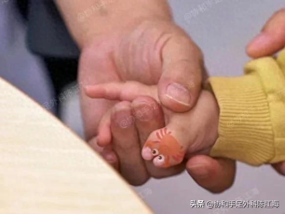 多指手术怎么做？多指手术不简单，费用多少？术后如何护理？