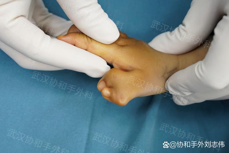 蟹钳样多指手术_IV-D型多指_做多指手术要多少钱