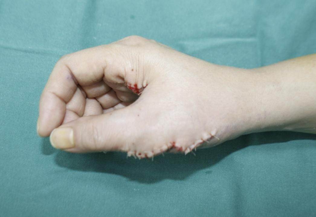 36岁多指畸形术后仍畸形_多指切除简单一刀切术后仍需二次矫正_做多指手术要多少钱